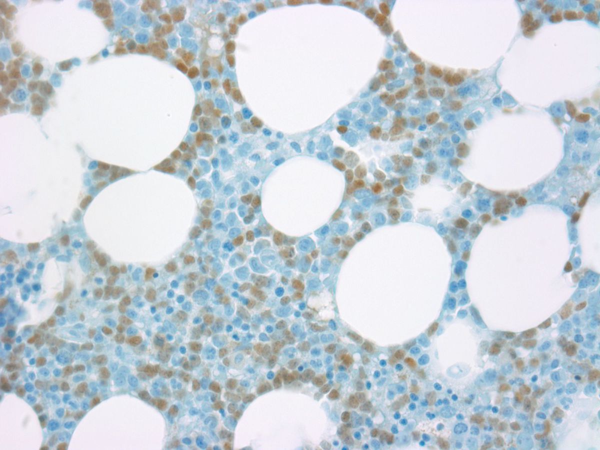 Bone marrow biopsy: TdT positive blasts